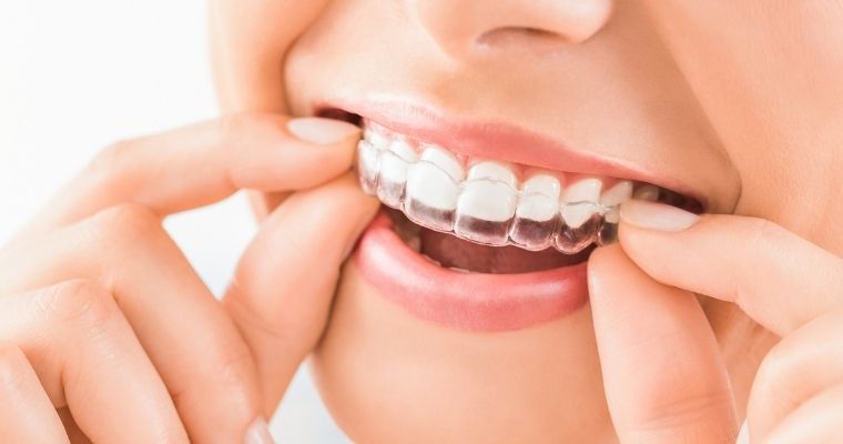 Invisalign Attachments: Top 7 Questions & Answers